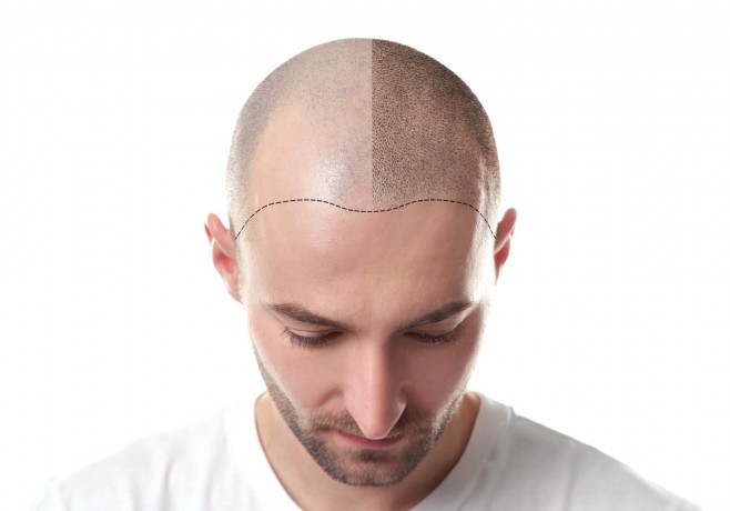 La greffe de cheveux comme solution pour retrouver une densité capillaire